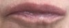 botox.JPG
